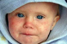 Những điều cần biết về bệnh ban đỏ ở trẻ em