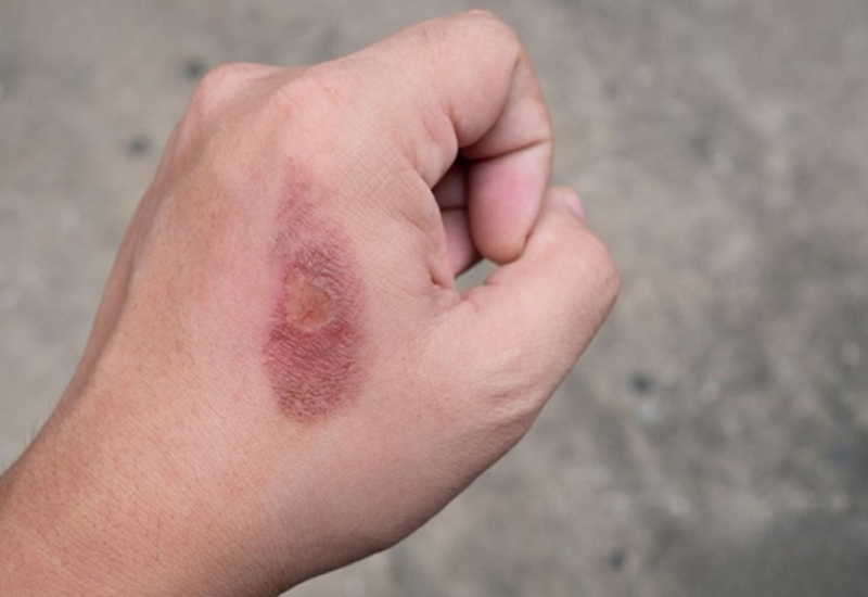 Bỏng cấp 1