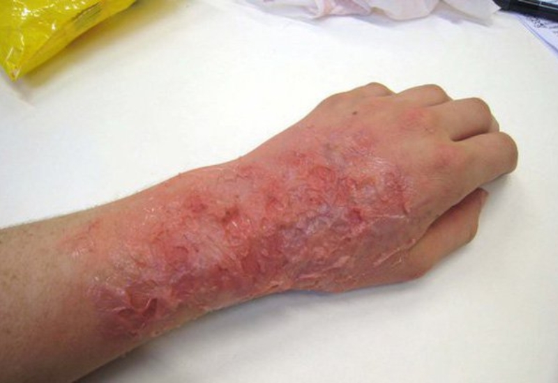 Bỏng cấp 3