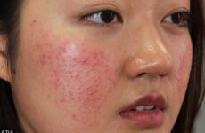 Cách nhận biết dị ứng mỹ phẩm nặng