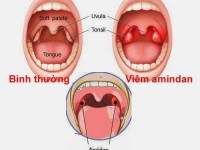 Cách chữa hôi miệng và sự thật về bệnh hôi miệng mà bạn chưa biết