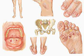 chamydia-benh-tinh-duc-o-nam-gioi