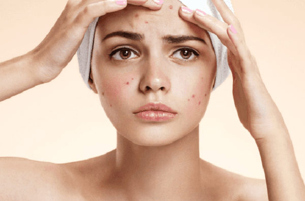 dieu-tri-da-nhon-mun