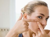 Thói quen sai lầm trong điều trị mụn trứng cá