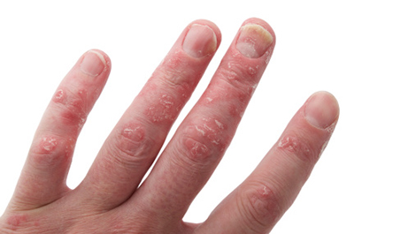 psoriatic-arthritis-tab-2-opt
