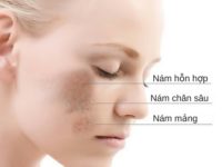Phương pháp trị nám hiệu quả cho da dầu